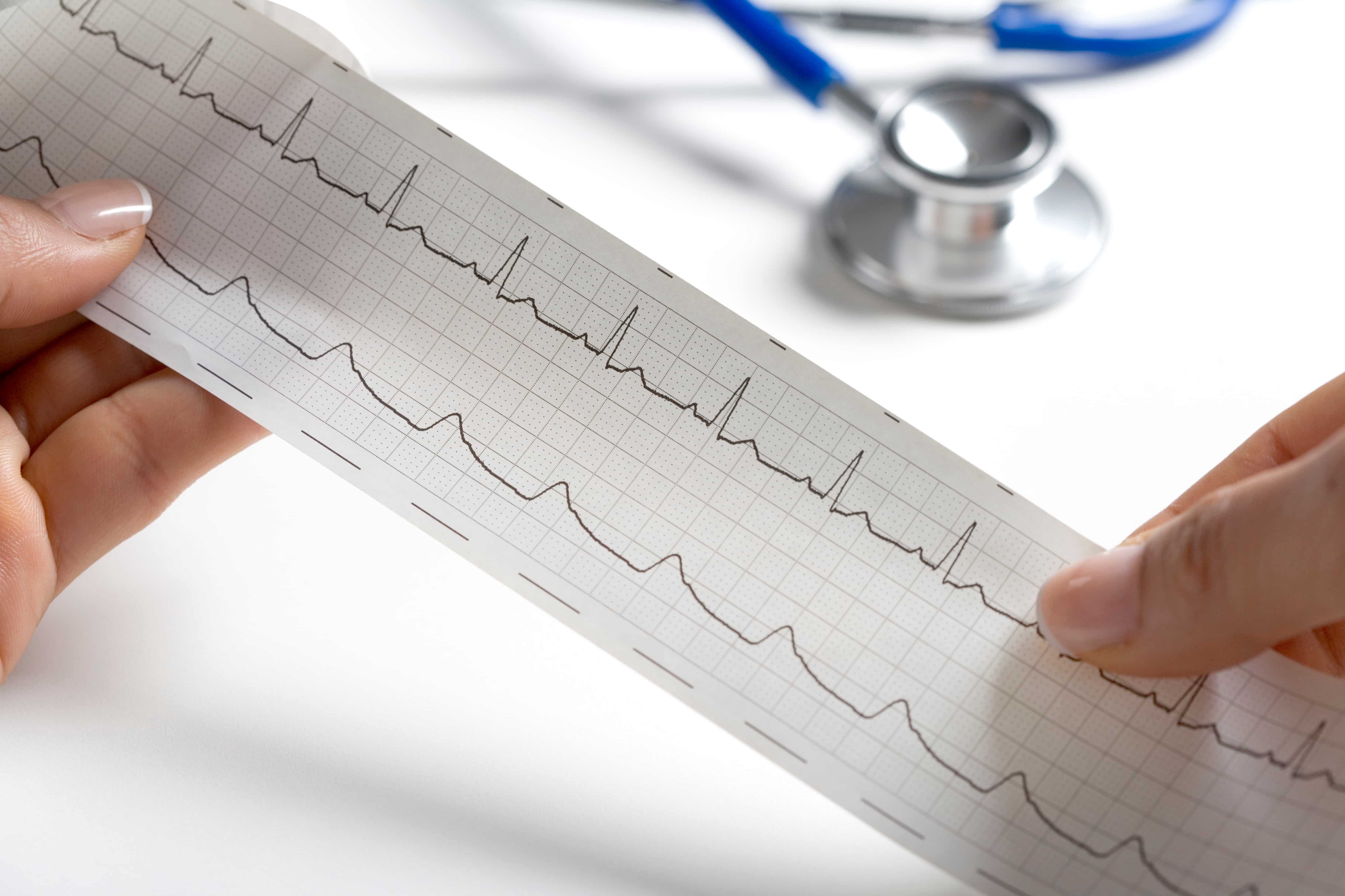 ECG
